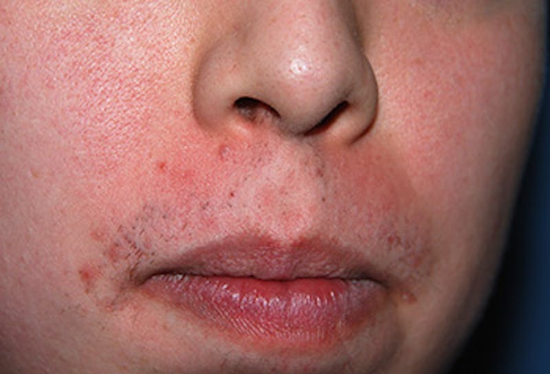 Skin Lesion & Mole Removal Before & After Gallery - Patient 134224 - Image 1