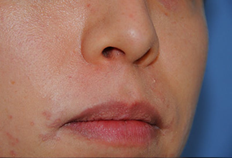 Skin Lesion & Mole Removal Before & After Gallery - Patient 134224 - Image 2