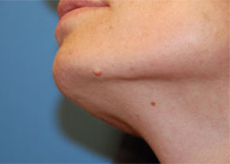 Skin Lesion & Mole Removal Before & After Gallery - Patient 340898 - Image 1