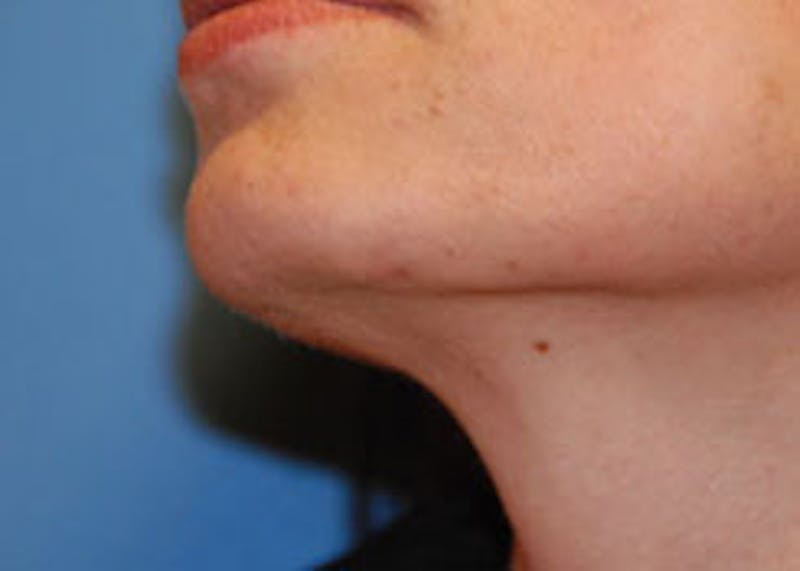 Skin Lesion & Mole Removal Before & After Gallery - Patient 340898 - Image 2
