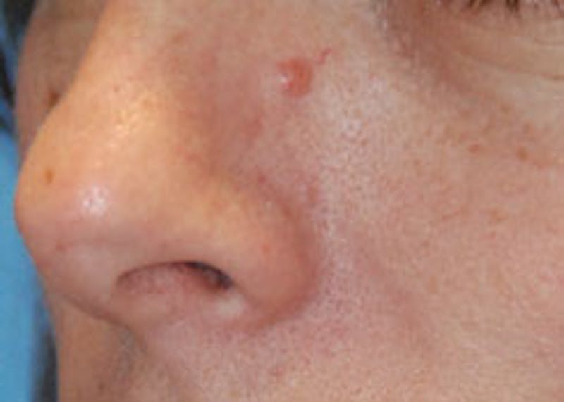 Skin Lesion & Mole Removal Before & After Gallery - Patient 368736 - Image 1