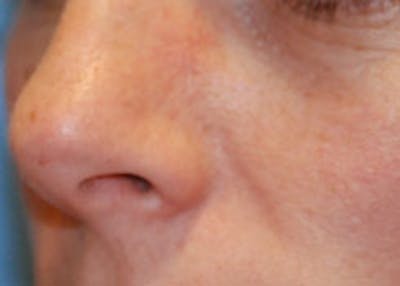 Skin Lesion & Mole Removal Before & After Gallery - Patient 368736 - Image 2