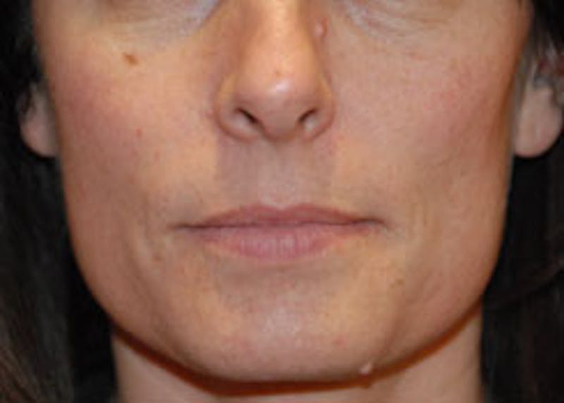 Skin Lesion & Mole Removal Before & After Gallery - Patient 393217 - Image 1