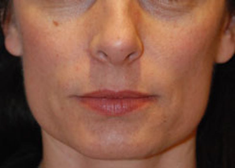 Skin Lesion & Mole Removal Before & After Gallery - Patient 393217 - Image 2