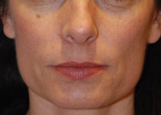 Skin Lesion & Mole Removal Before & After Gallery - Patient 393217 - Image 2