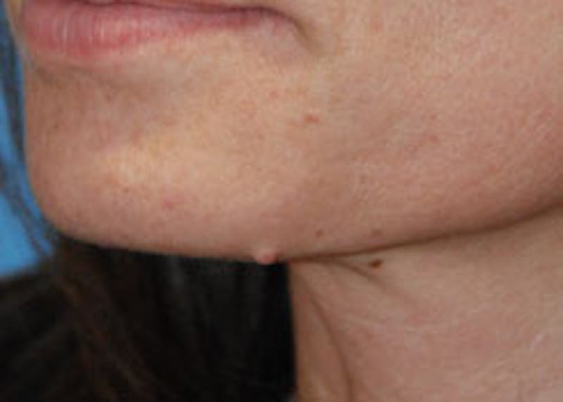Skin Lesion & Mole Removal Before & After Gallery - Patient 393217 - Image 3