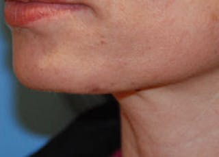 Skin Lesion & Mole Removal Before & After Gallery - Patient 393217 - Image 4