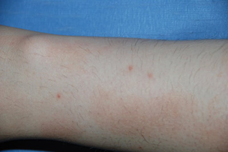 Laser Resurfacing Before & After Gallery - Patient 180637 - Image 1