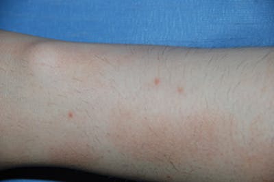 Skin Lesion & Mole Removal Before & After Gallery - Patient 400526 - Image 1
