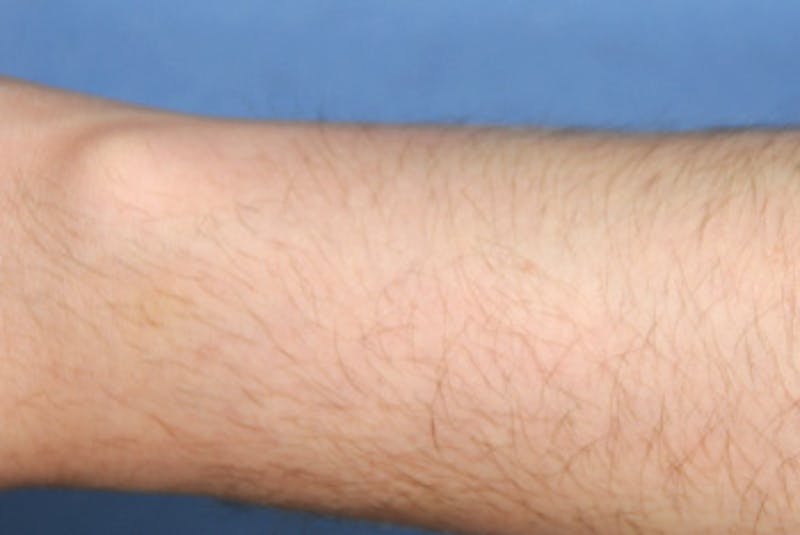 Laser Resurfacing Before & After Gallery - Patient 180637 - Image 2