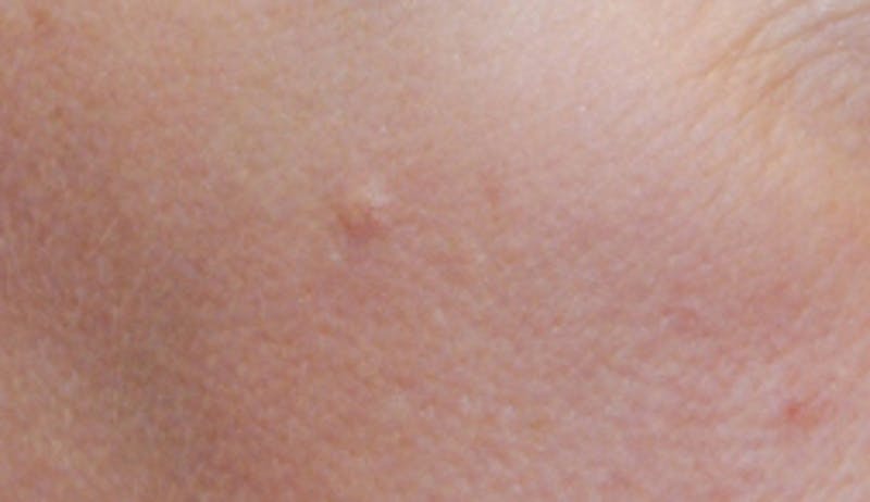 Skin Lesion & Mole Removal Before & After Gallery - Patient 185616 - Image 1