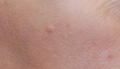 Skin Lesion & Mole Removal Before & After Gallery - Patient 185616 - Image 1