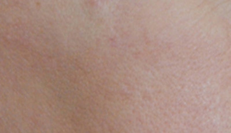 Skin Lesion & Mole Removal Before & After Gallery - Patient 185616 - Image 2