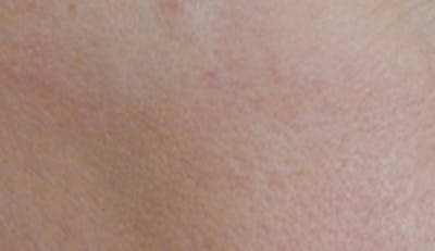 Skin Lesion & Mole Removal Before & After Gallery - Patient 185616 - Image 2
