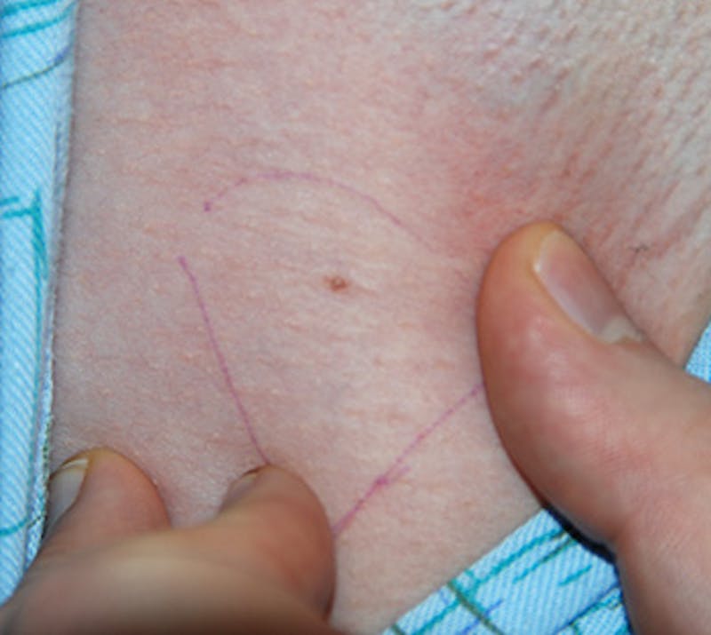 Laser Resurfacing Before & After Gallery - Patient 547328 - Image 1
