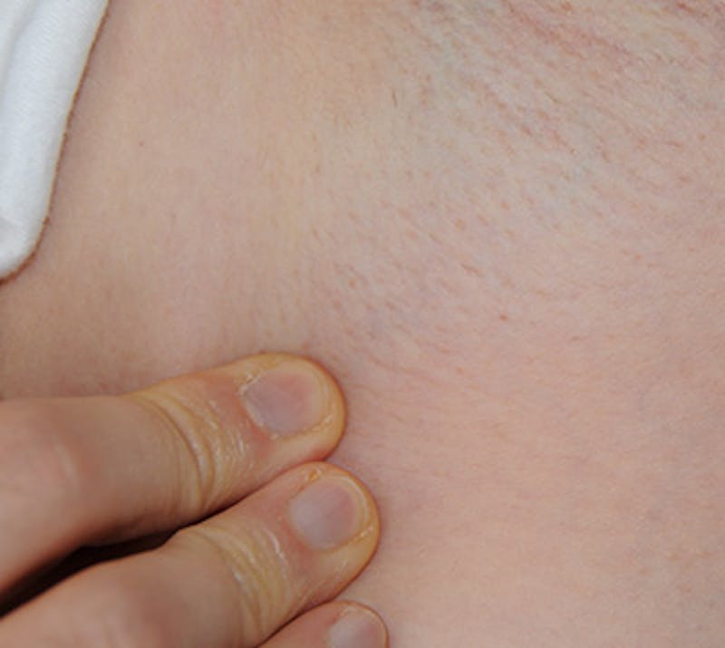 Laser Resurfacing Before & After Gallery - Patient 547328 - Image 2