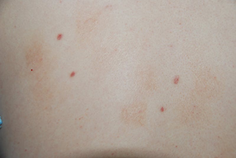 Laser Resurfacing Before & After Gallery - Patient 375325 - Image 1