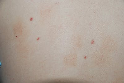 Skin Lesion & Mole Removal Before & After Gallery - Patient 194865 - Image 1