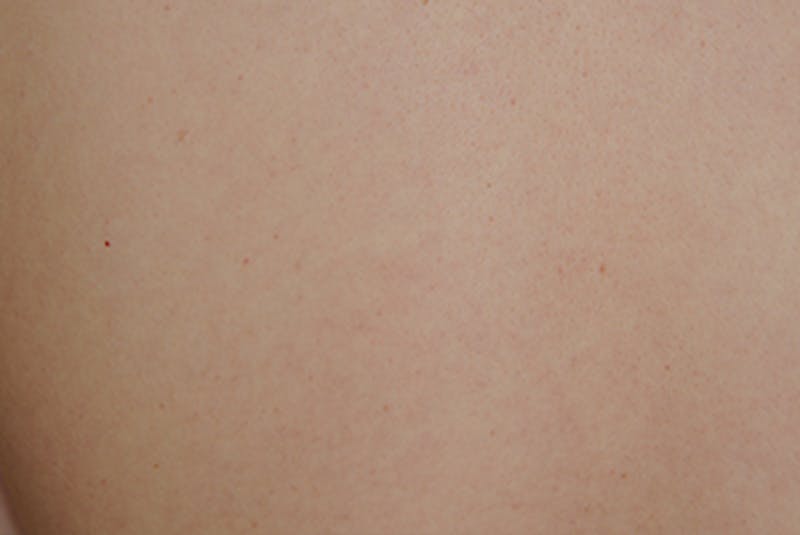 Laser Resurfacing Before & After Gallery - Patient 375325 - Image 2