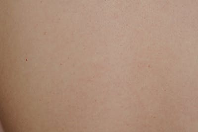 Skin Lesion & Mole Removal Before & After Gallery - Patient 194865 - Image 2