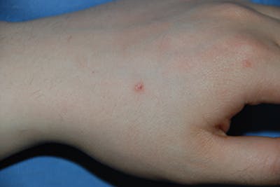 Skin Lesion & Mole Removal Before & After Gallery - Patient 354696 - Image 1