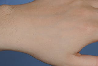 Skin Lesion & Mole Removal Before & After Gallery - Patient 354696 - Image 2
