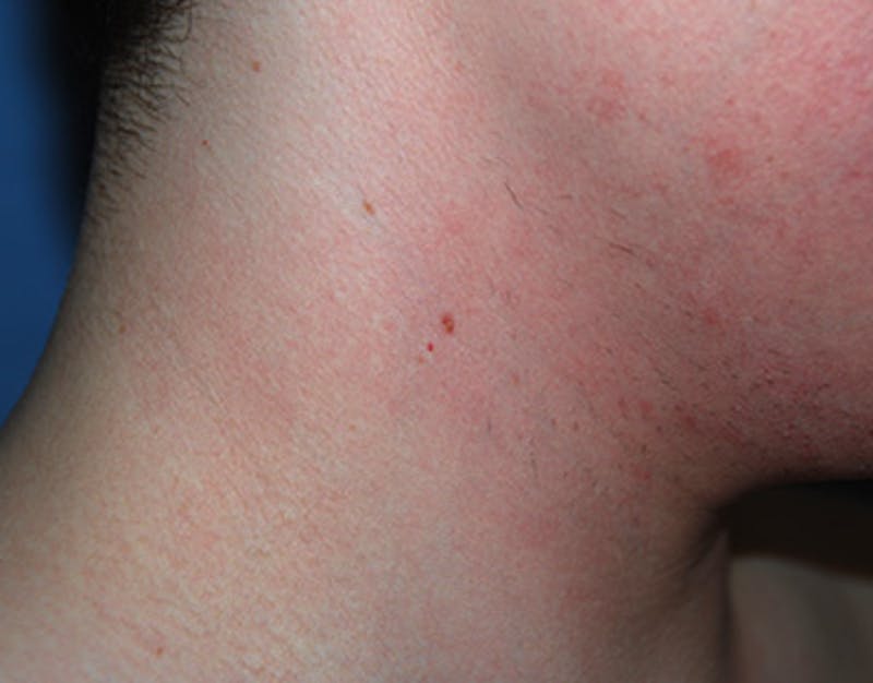 Skin Lesion & Mole Removal Before & After Gallery - Patient 354696 - Image 3