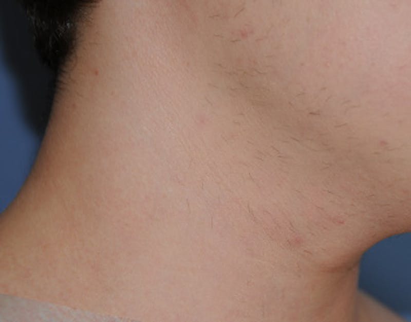 Skin Lesion & Mole Removal Before & After Gallery - Patient 354696 - Image 4