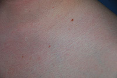 Laser Resurfacing Before & After Gallery - Patient 386227 - Image 1