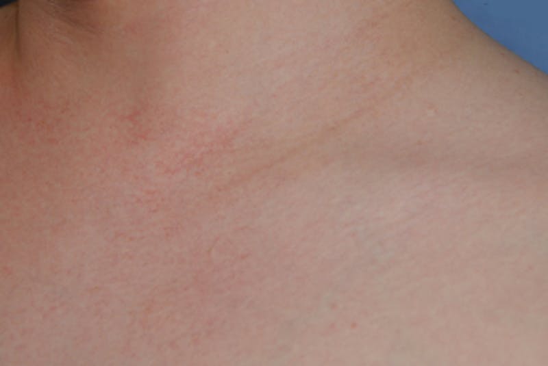 Skin Lesion & Mole Removal Before & After Gallery - Patient 354696 - Image 6