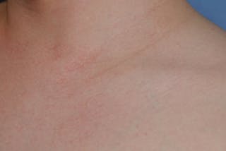 Skin Lesion & Mole Removal Before & After Gallery - Patient 354696 - Image 6