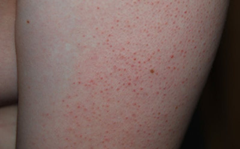 Skin Lesion & Mole Removal Before & After Gallery - Patient 354696 - Image 7