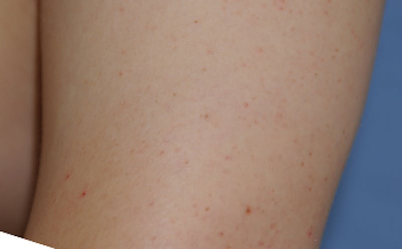 Skin Lesion & Mole Removal Before & After Gallery - Patient 354696 - Image 8