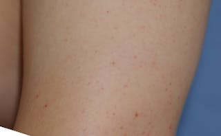 Skin Lesion & Mole Removal Before & After Gallery - Patient 354696 - Image 8