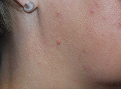 Skin Lesion & Mole Removal Before & After Gallery - Patient 482168 - Image 1