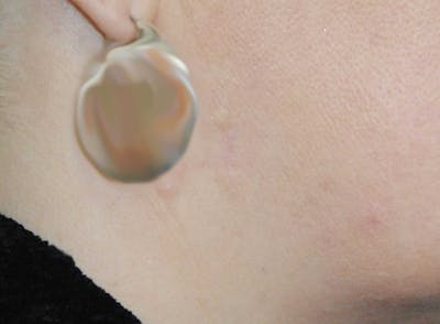 Skin Lesion & Mole Removal Before & After Gallery - Patient 482168 - Image 2