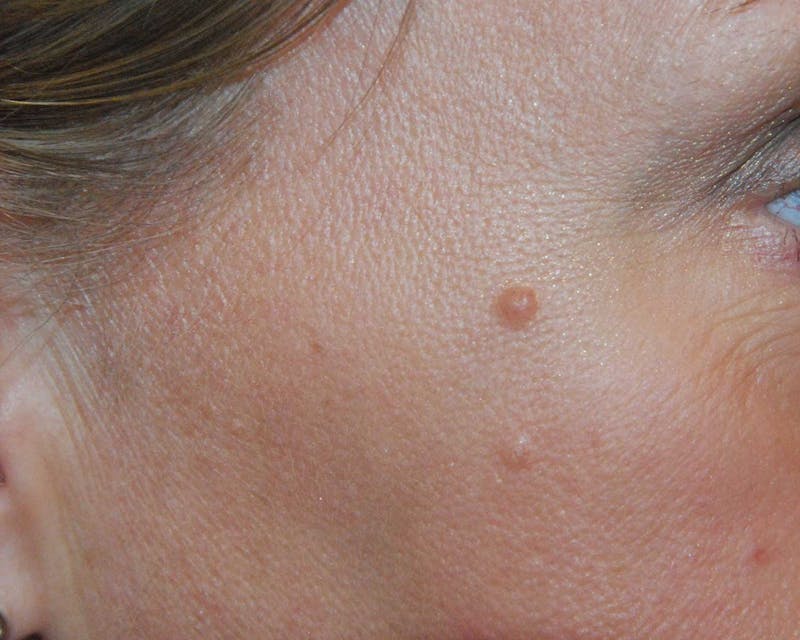 Skin Lesion & Mole Removal Before & After Gallery - Patient 284383 - Image 1