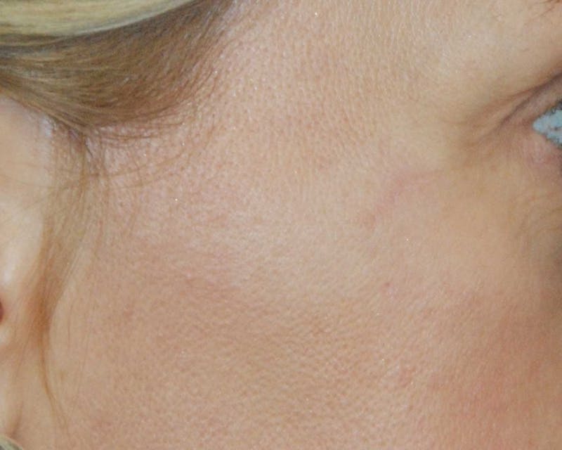 Skin Lesion & Mole Removal Before & After Gallery - Patient 284383 - Image 2