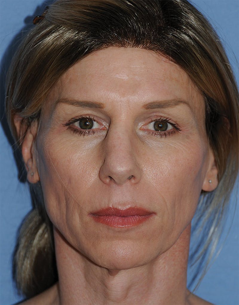 Transgender Surgery Before & After Gallery - Patient 897232 - Image 5