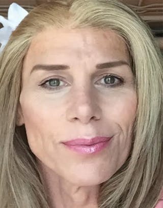 Transgender Surgery Before & After Gallery - Patient 897232 - Image 6