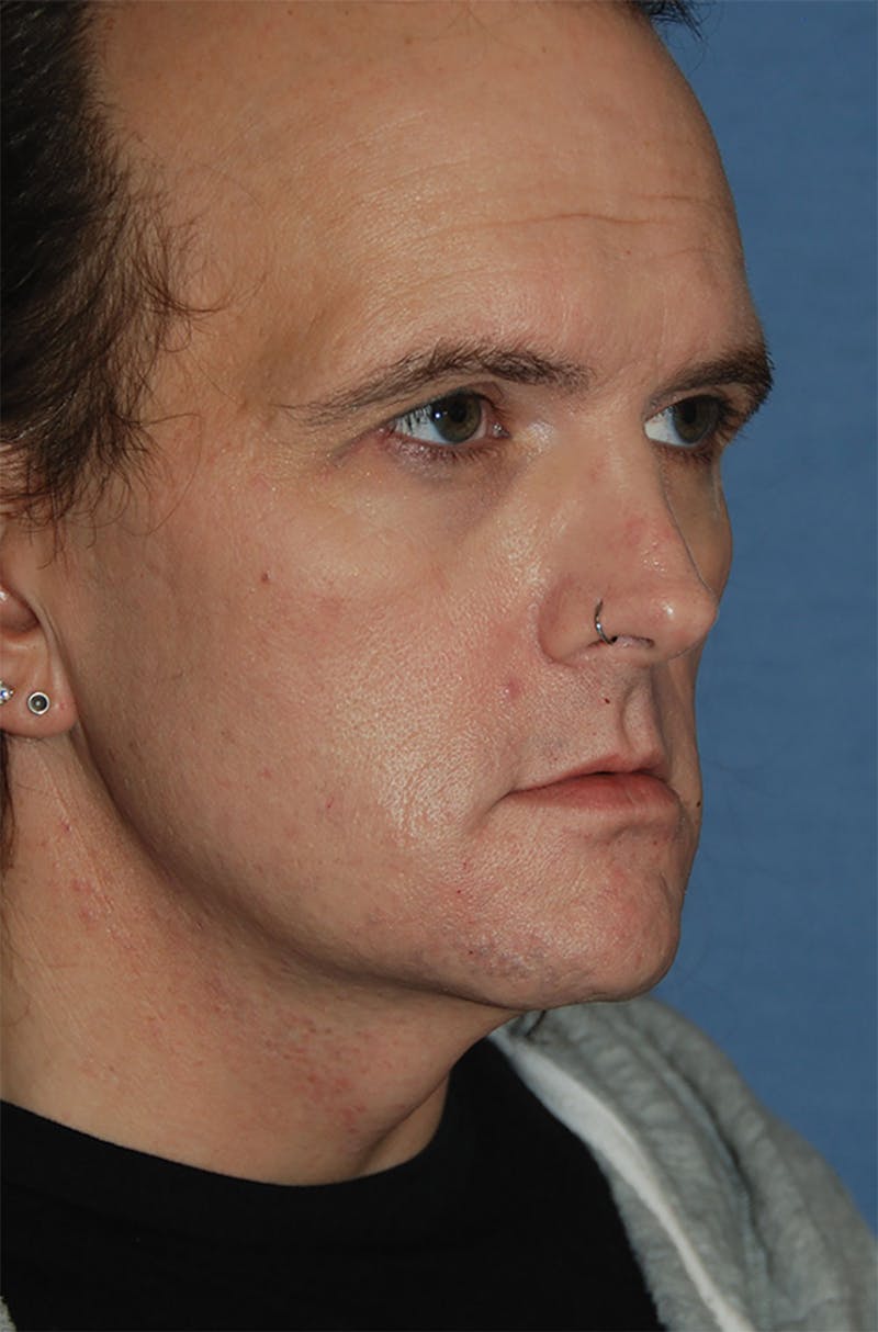 Transgender Surgery Before & After Gallery - Patient 263469 - Image 7