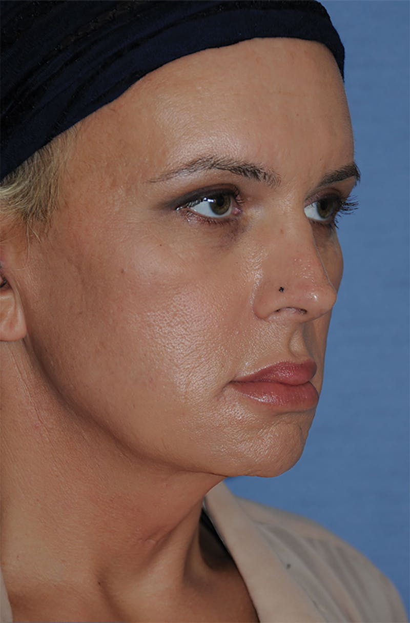 Transgender Surgery Before & After Gallery - Patient 263469 - Image 8