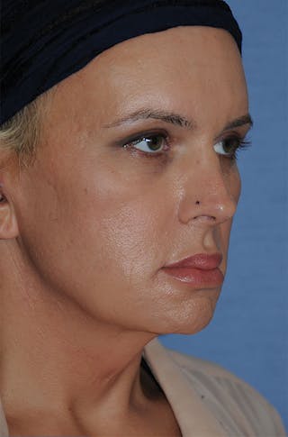 Transgender Surgery Before & After Gallery - Patient 263469 - Image 8