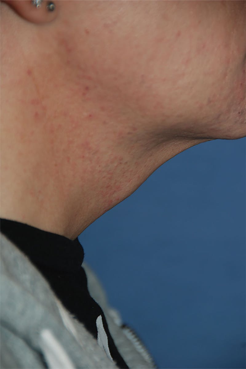 Transgender Surgery Before & After Gallery - Patient 263469 - Image 9