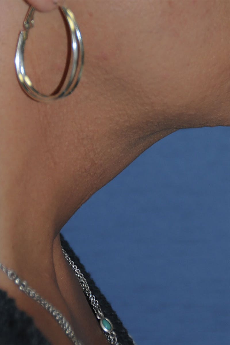 Transgender Surgery Before & After Gallery - Patient 263469 - Image 10