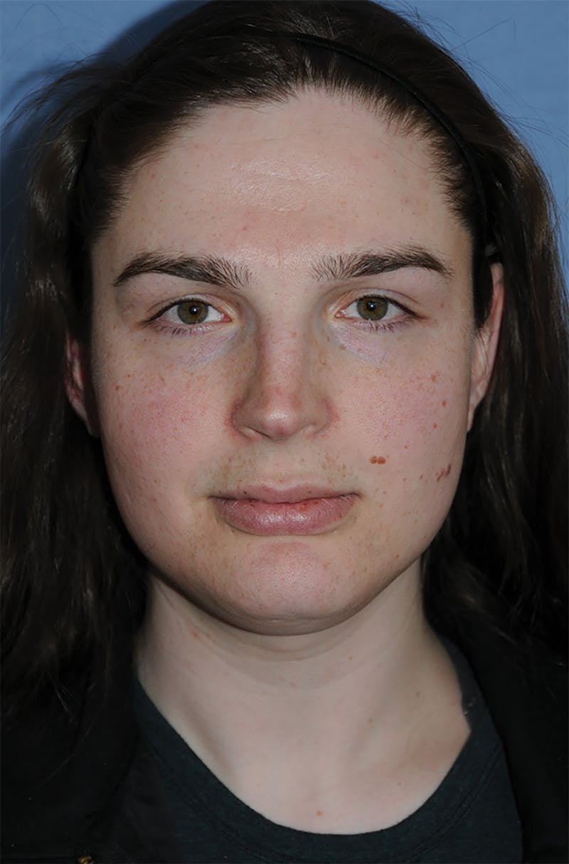 Transgender Surgery Before & After Gallery - Patient 296177 - Image 1