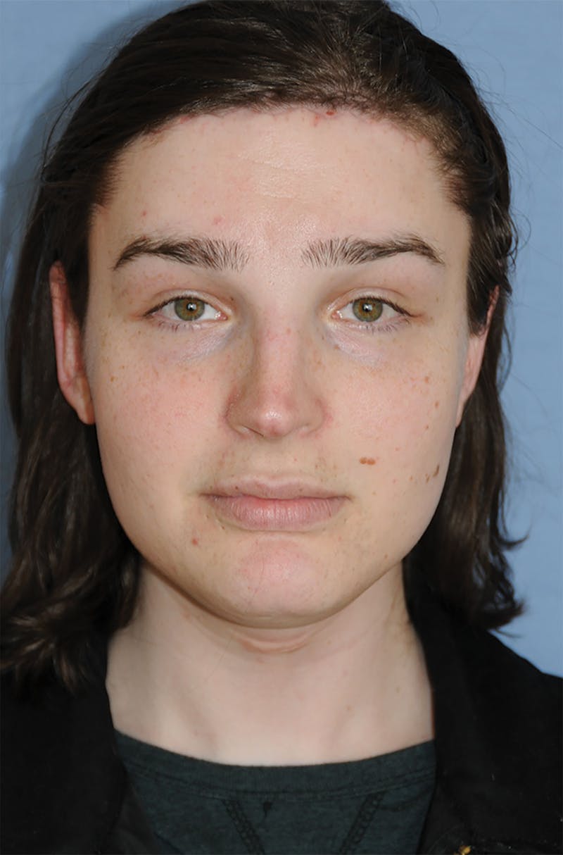 Transgender Surgery Before & After Gallery - Patient 296177 - Image 2