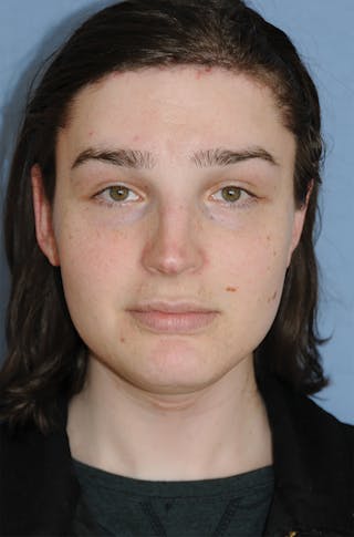 Transgender Surgery Before & After Gallery - Patient 296177 - Image 2