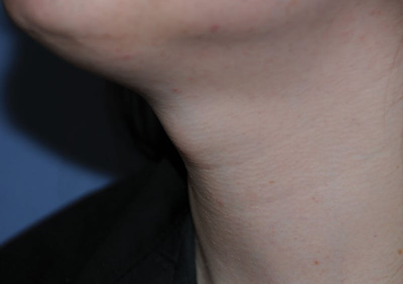 Transgender Surgery Before & After Gallery - Patient 296177 - Image 3