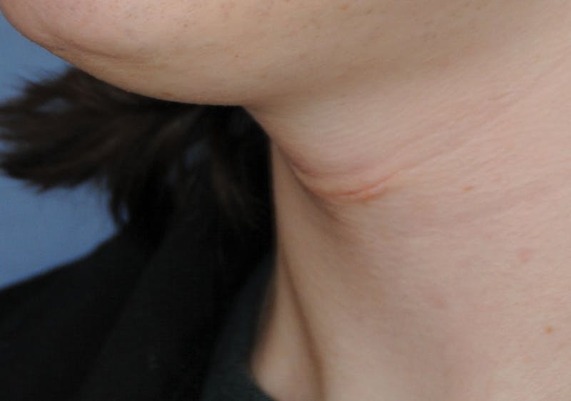 Transgender Surgery Before & After Gallery - Patient 296177 - Image 4